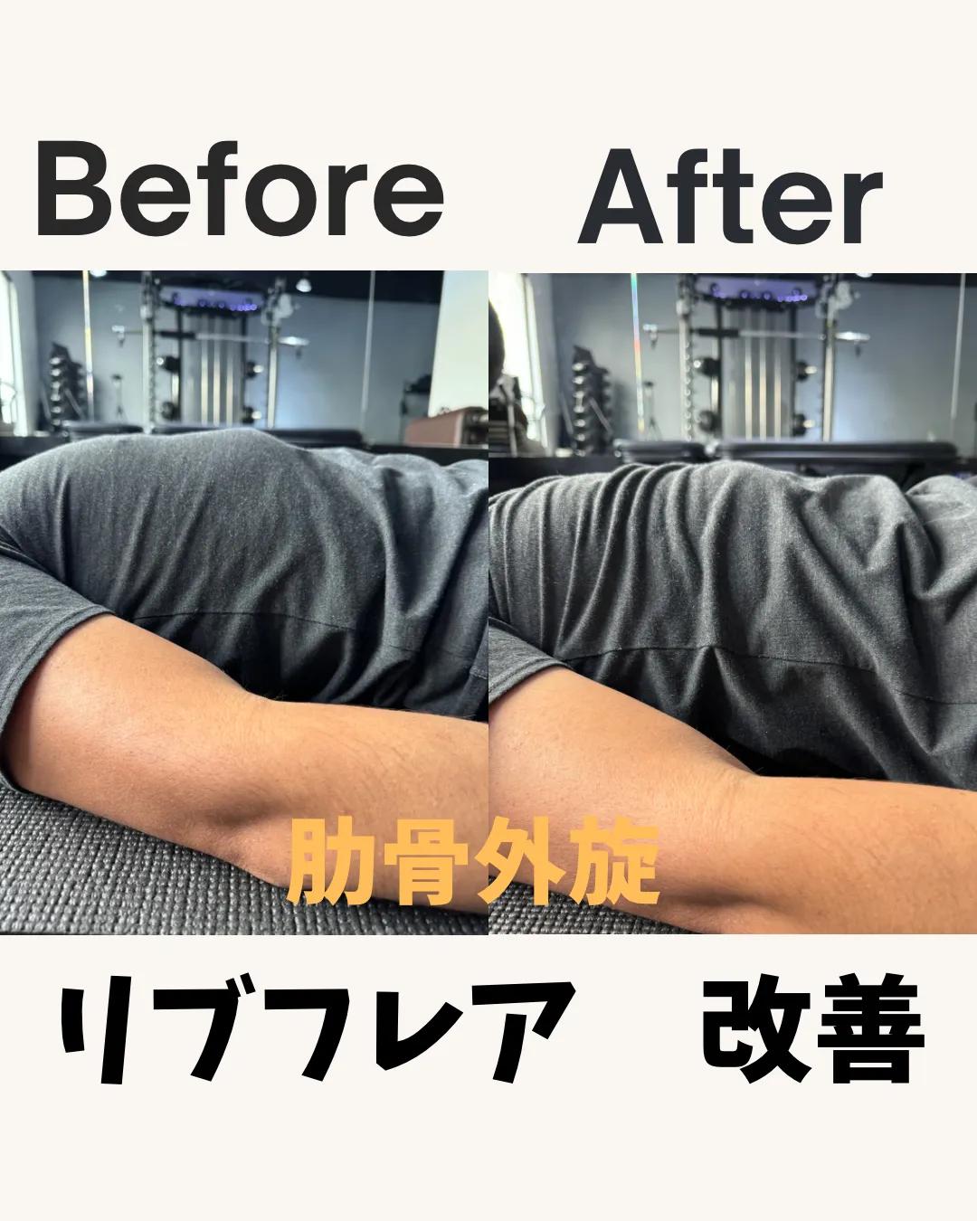 ビフォーアフター — 肋骨外旋（リブフレア）の改善