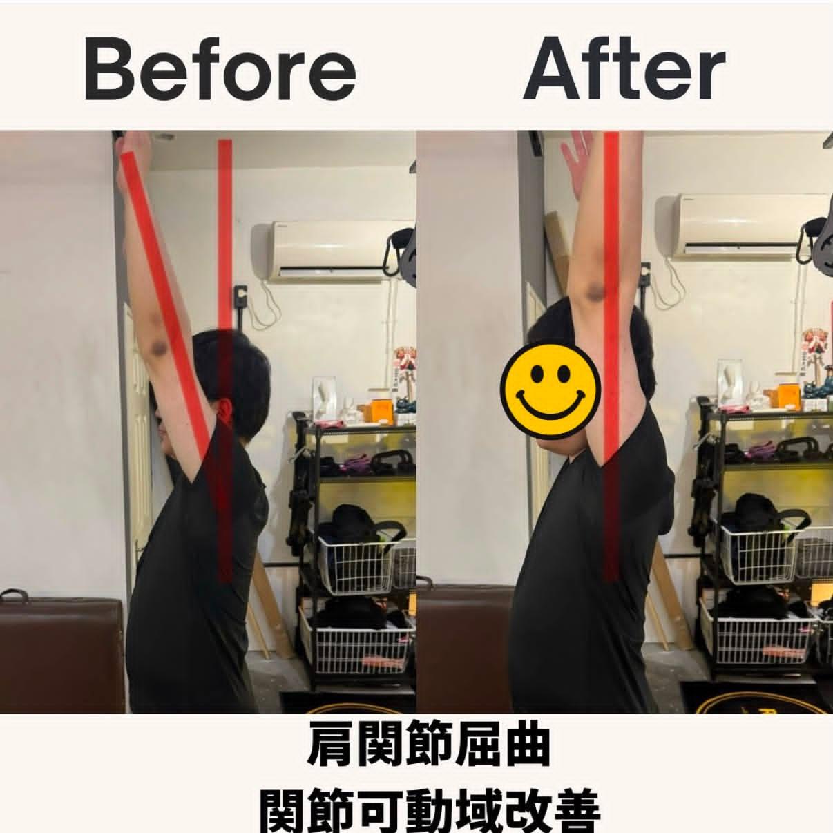 ビフォーアフター — 肩関節屈曲の可動域改善。腕がまっすぐ耳の横まで上がるように。